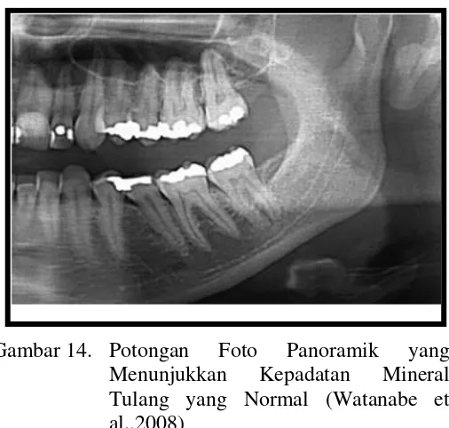 Gambar 15.  Potongan Dua Foto Panoramik yang Menunjukkan Berkurangnya Kepadatan Mineral Tulang Mandibula yang Dapat Dilihat dari Gambaran Radiolusen (Watanabe et al.,2008) 