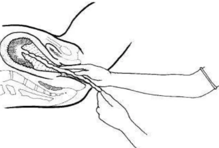 Gambar 2.2 Memasukkan tangan menyusuri tali puasat  (Saifuddin AB, 2002 : P-42) 
