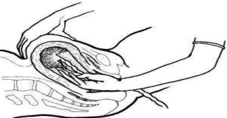 Gambar 2.3 Menahan fundus sewaktu melepas plasenta  (Saifuddin AB, 2002 :P-43) 