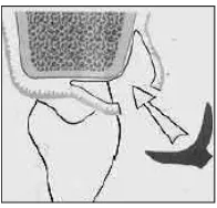 Gambar 18: Gambaran skematis menggambarkan cangkok jaringan ikat yang disisipkan di bawah flep pada daerah interdental (Krishnan IS