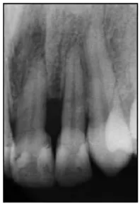 Gambar 31:  Modifikasi ruang interdental yang ditujukan untuk perawatan ortodonti : kasus klinis sebelum terapi (Prato GPP