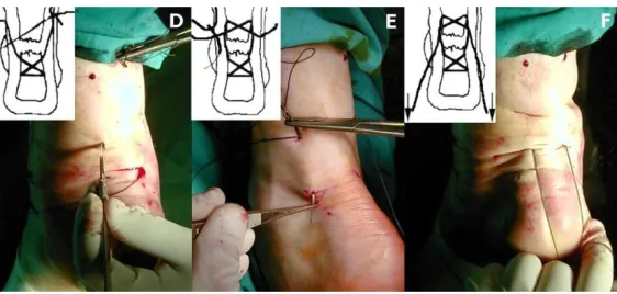 Gambar 2.8: Percutaneous Surgery