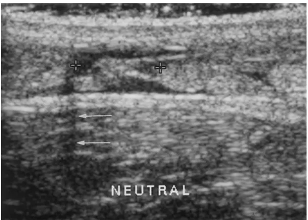 Gambar 2.4: Gambaran ruptur tendon Achilles dengan plain radiograph