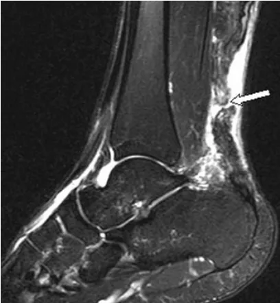 Gambar 2.6: Gambaran MRI ruptur tendon achilles