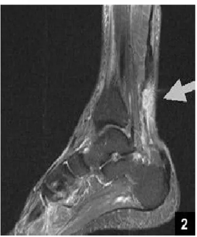 Gambar 11. MRI Tendon Achilles