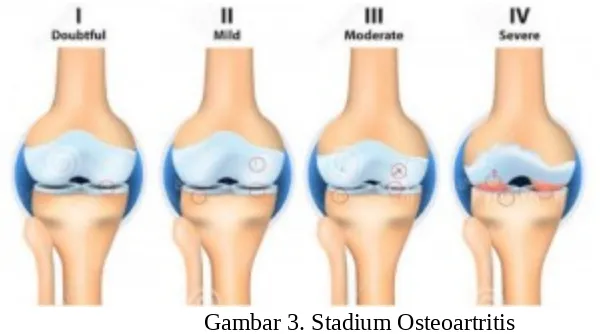Gambar 3. Stadium Osteoartritis