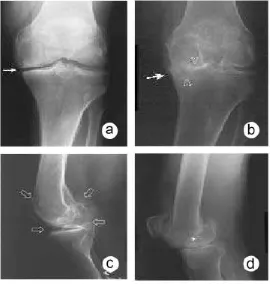 Gambar 8. Pencitraan radiologis sinar-x pada osteoartritis lutut.