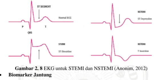 Gambar 2. 8 EKG untuk STEMI dan NSTEMI (Anonim, 2012)    Biomarker Jantung 