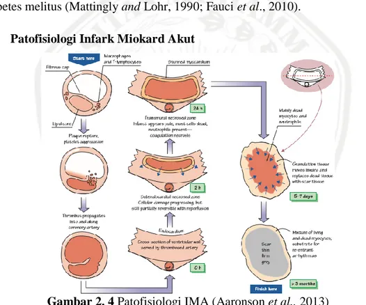 Gambar 2. 4 Patofisiologi IMA (Aaronson et al., 2013) 