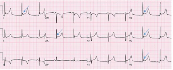 Gambar 1. EKG pada BER dengan elevasi Segmen-ST dengan J Notching pada sadapan I, II, aVL, V2-V6 1