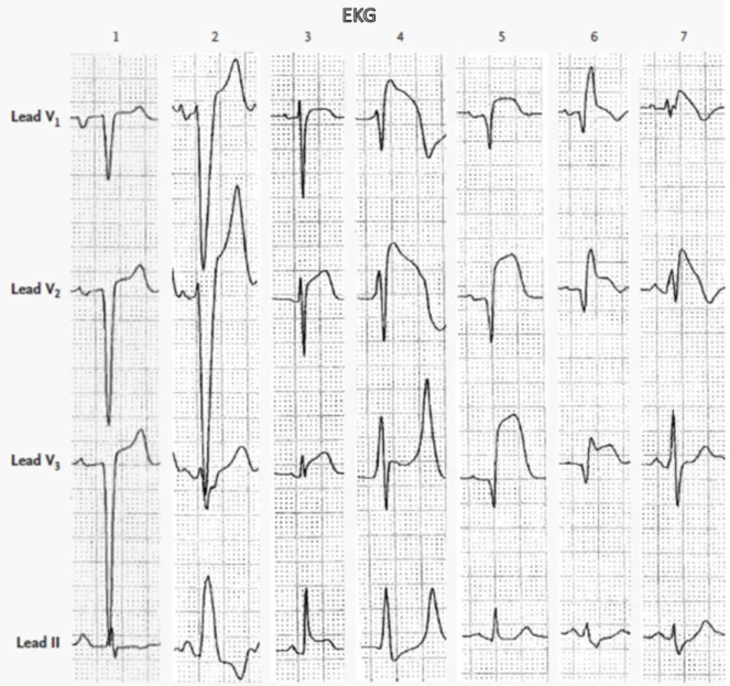 Gambar 1. LVH (EKG 1), LBBB (EKG 2), Pericarditis Akut (EKG 3), Pseudoinfark pada Hiperkalemia (EKG 4), STEMI Anteroseptal 