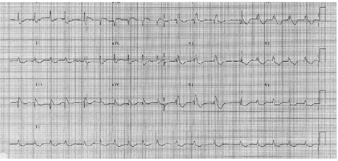 Gambar 4. Gambaran EKG pada Emboli Paru dimana ditemukan gambaran S1Q3T3 dengan inversi gelombang T di V1-V6, 