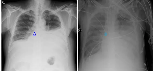 Gambar 1. X-foto thoraks pre dan post WSD (A) Gambar efusi pleura masif sinistra  (B) Gambar REPE post pemasangan WSD