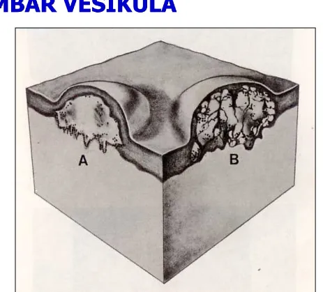 GAMBAR VESIKULA