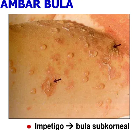 GAMBAR BULA Impetigo  bula subkorneal