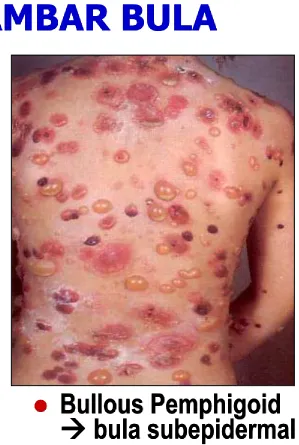 GAMBAR BULA Bullous Pemphigoid  bula subepidermal