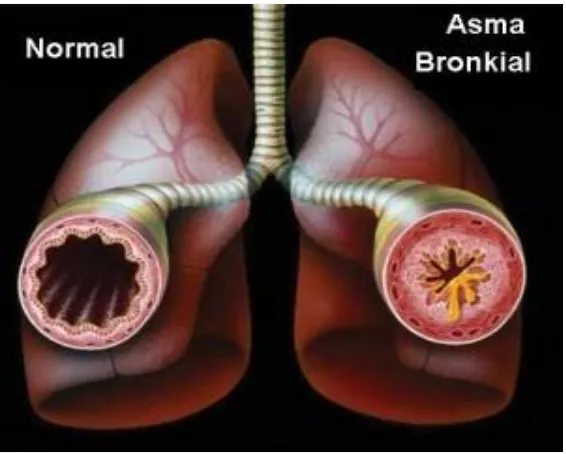 Gambar 2.1. Normal dan Asma Bronkial11 