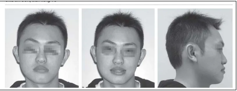 Gambar 1. Asimetri wajah pada pasien gigitan terbalik anterior maloklusi Klas III  14 