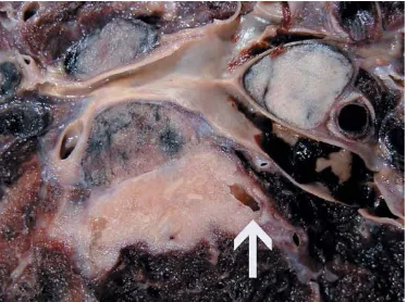 Gambar 2.11 Gambar sitologi small cell carcinoma. Terlihat kelompok sel saling berlengketan dengan bebas