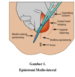 Gambar 1. Episiotomi Medio-lateral 