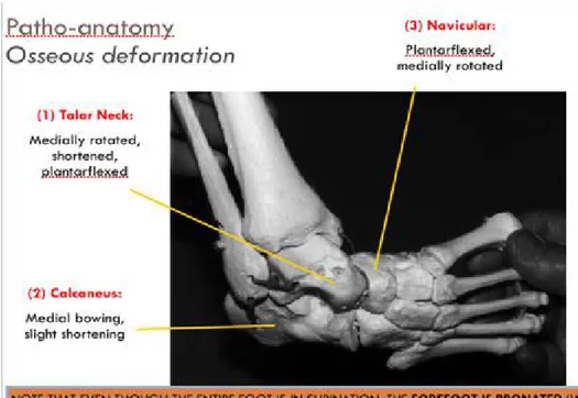 Gambar 2.2.2 Anatomi cluboot 2.2.3 EPIDEMIOLOGI