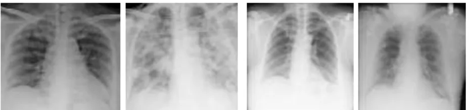 Gambar 1. Citra X-ray dada terinfeksi COVID-19 (dua gambar di kiri) dan citra  X-ray dada tidak terinfeksi COVID-19 (dua gambar di kanan) 