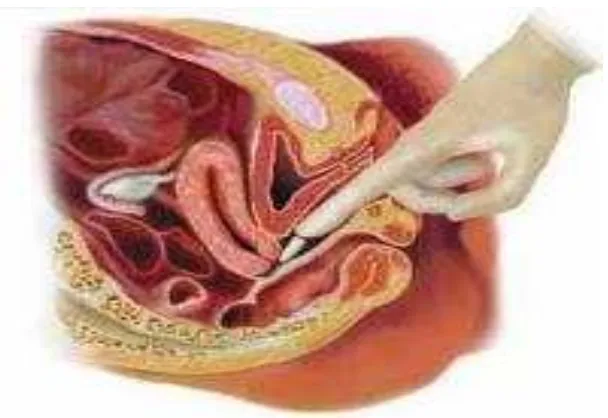 Gambar 5. Cara meletakkan kapsul suppositoria intravagina 