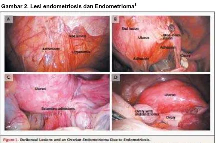 Gambar 2. Lesi endometriosis dan Endometrioma8 