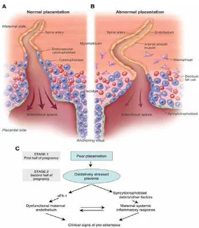 Gambar 2.1.  Etiologi preeklampsia menurut teori iskemik plasentaImplantasi plasenta pada kehamilan normal dan PE Implantasi plasenta normal yang memperlihatkan proliferasi trofoblas ekstravilus membentuk satu kolom di bawah vilus spiralis