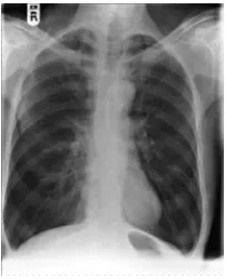 Gambar 3.  Gambaran radiologi penderita PPOK.28 