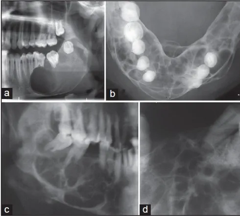 Gambar 4.  Penampilan macam-macam pola ameloblastoma pada radiograf,  (A) tipe unikistik, (B) spider-web, (C) soap-bubble dan (D) honeycomb 11