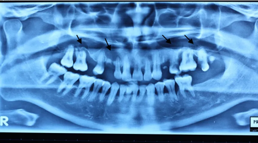 Gambar 1. Gambaran radiologis kista radikular pada apeks gigi 16, 13-12, 25-26, dan 26-27