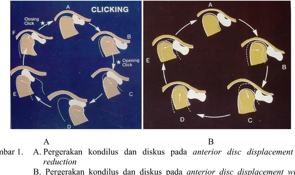 Gambar 1.   A. Pergerakan  kondilus  dan  diskus  pada  anterior  disc  displacement  with 