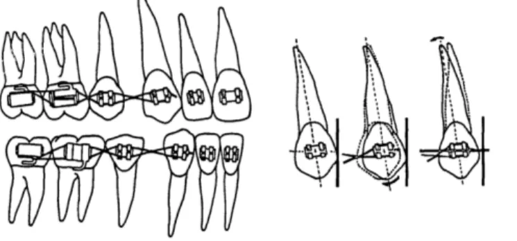 Gambar 2. Laceback untuk retraksi kaninus (diambil dari McLaughlin RP, Bennett JC, Angle 