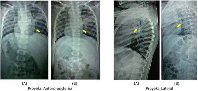 Gambar 3. Foto rontgen tulang belakang dua proyeksi sebelum penatalaksanaan (A) dan sesudah  penatalaksanaan (B)