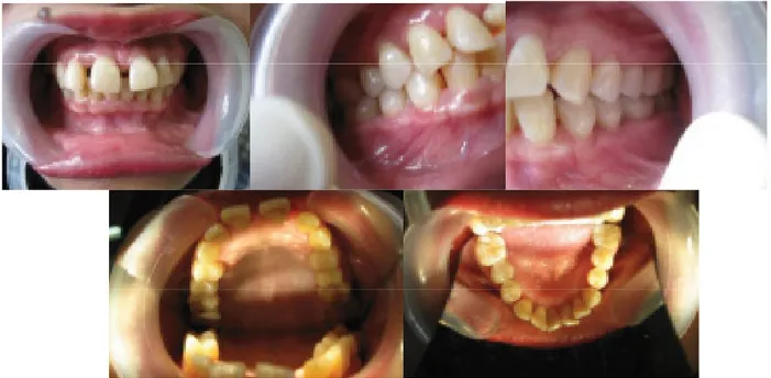 Gambar 2. Kondisi gigi geligi sebelum perawatan