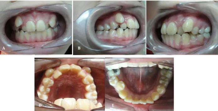 Gambar 1. Fotografi intraoral sebelum perawatan : A) Frontal; B) Sisi Kanan; C) Sisi Kiri; D) Oklusal Atas; 