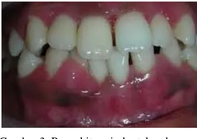 Gambar 3. Penyakit periodontal pada                 penderita Diabetes melitus14  