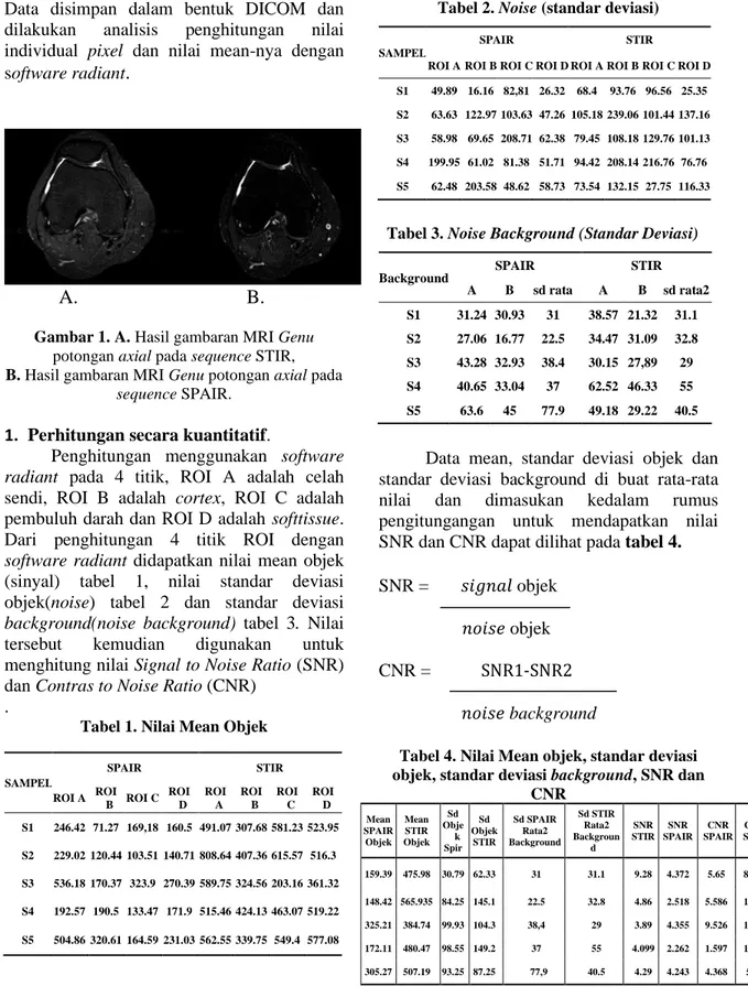 Gambar 1. A. Hasil gambaran MRI Genu  potongan axial pada sequence STIR,   B. Hasil gambaran MRI Genu potongan axial pada 