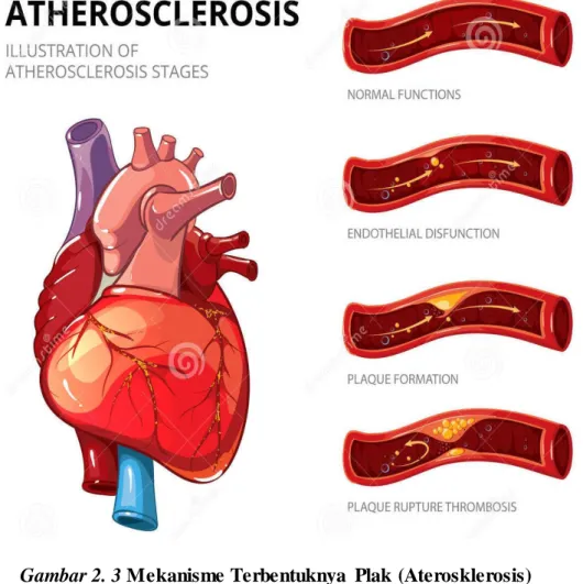 Gambar 2. 3 Mekanisme Terbentuknya  Plak (Aterosklerosis)   