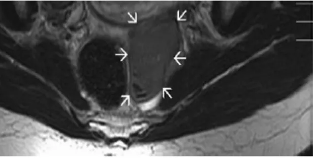 Gambar 5. Gambaran endometrioma ovarium pada pemeriksaan MRI. (25) 