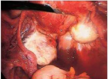 Gambar 1. Endometriosis pada ligamen uterosakral (20) 