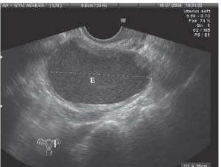 Gambar 4. Gambaran Ultrasound Transvaginal pada endometrioma 