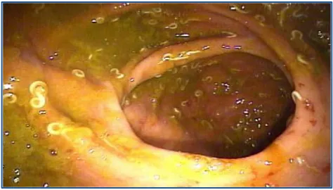 Gambar 4. Prolapsus rectum 