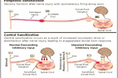 Gambar 1. Sensitasi sistem saraf perifer dan sistem saraf pusat pada PHN    (dikutip dari kepustakaan no 11) 