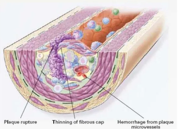 Gambar 2.4 Trombus pada pembuluh darah ( Ross, 1999 ) 