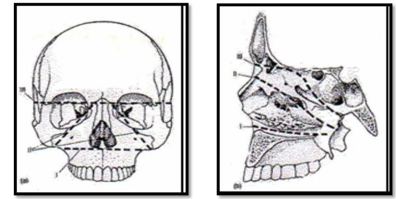 Gambar 12.(A). Le Fort I, Le Fort II, Le Fort III (pandangan anterior) (B).Le Fort 