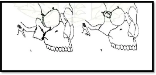 Gambar 3. Fraktur pada daerah mandibula A. Dento-alveolar B. Kondilar C. 
