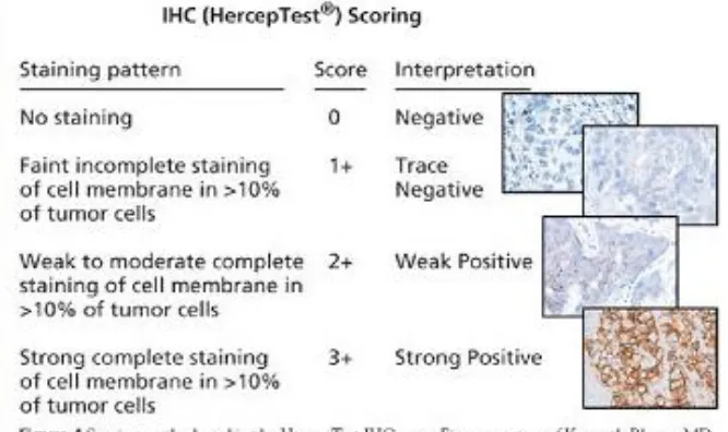 Tabel 2.1 : Test ekspresi HER2 dengan IHC (Sumber : Carlson RW, et al. J Natl Compr Canc Netw