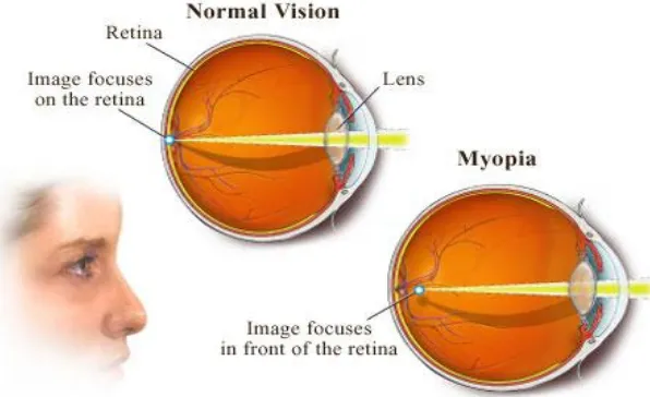 Gambar 2.1.Penglihatan Normal dan Penglihatan Miopia